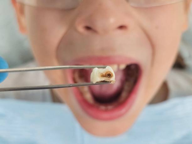 Best Urgent Tooth Repair  in Lake Magdalene, FL